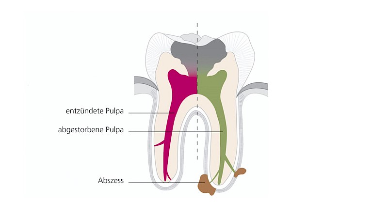 Schäden an der Zahnwurzel